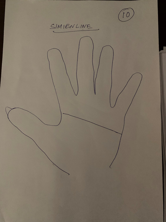 Hand-drawn palm captioned "Simian line", a single crease running straight across the palm where the head and heart lines would separately lie