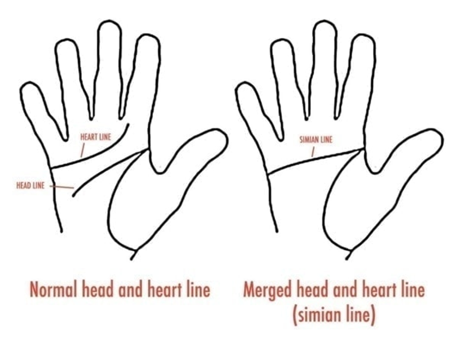 Two palm diagrams side by side: on the left a normal hand with the heart line and head line labelled and separate, on the right a hand where they merge into a single simian line