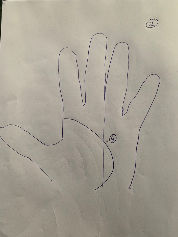 Hand-drawn palm where the life line curves tightly around the thumb and ends on the Venus mount, with a vertical line running past it