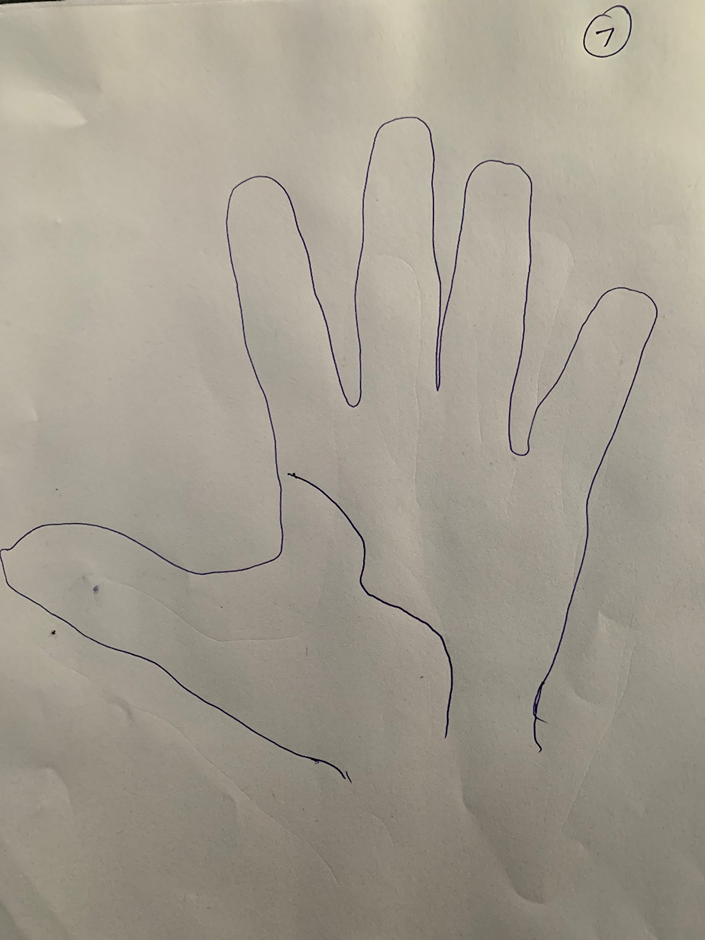 Hand-drawn palm where the life line is drawn as a wavy, uneven curve around the thumb